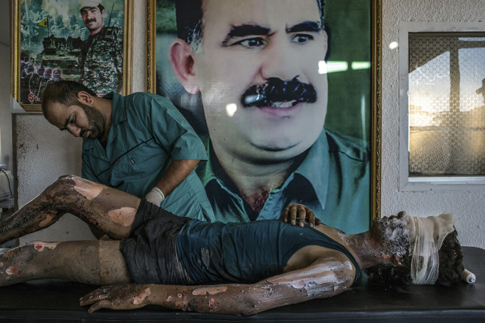 3. Hasaka, Syria - August 1, 2015 A doctor rubs ointment on the burns of Jacob, 16, in front of a poster of Abdullah Ocalan, center, the jailed leader of the Kurdistan Workers' Party, at a YPG hospital compound on the outskirts of Hasaka. According to YPG fighters at the scene, Jacob is an ISIS fighter from Deir al-Zour and the only survivior from an ambush made by YPG fighters over a truck alleged to carry ISIS fighters on the outskirts of Hasaka. Six ISIS fighters died in the attack, 5 of them completely disfigured by the explosion.