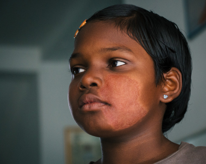 A young girl with a classic leprosy rash. Leprosy is curable, and she will have no longterm disabiity.